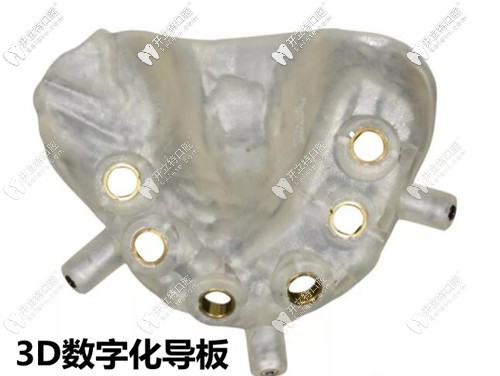 福州维乐口腔3D导板种植牙技术 福州维乐口腔3D导板种植牙技术