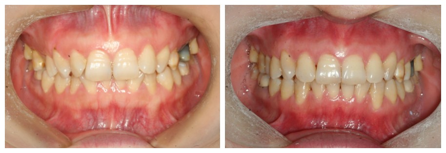 隐形牙套矫正深覆合没效果?她做时代天使不到2年告别了嘴凸