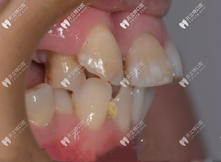 从侧面看大门牙突出很明显 从侧面看大门牙突出很明显