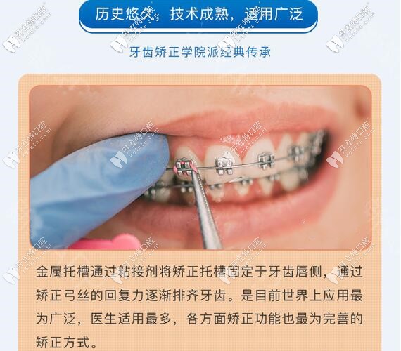 钢丝金属托槽牙齿矫正价格