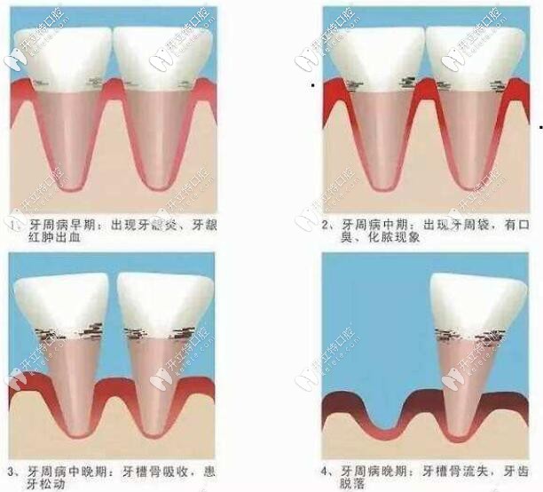 牙周炎的发展阶段