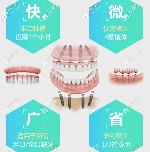 all-on-4全口种植技术 all-on-4全口种植技术