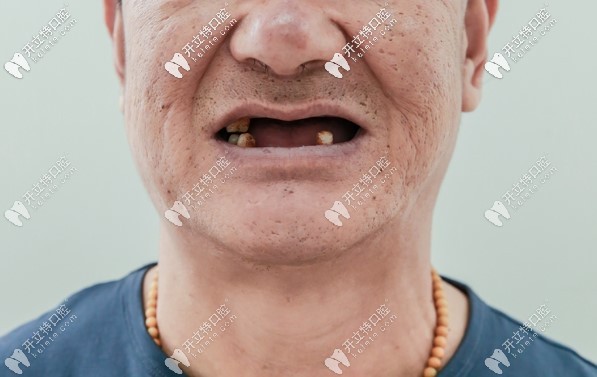 去北京海德堡联合口腔种牙前赵叔的口腔状况 去北京海德堡联合口腔种牙前赵叔的口腔状况