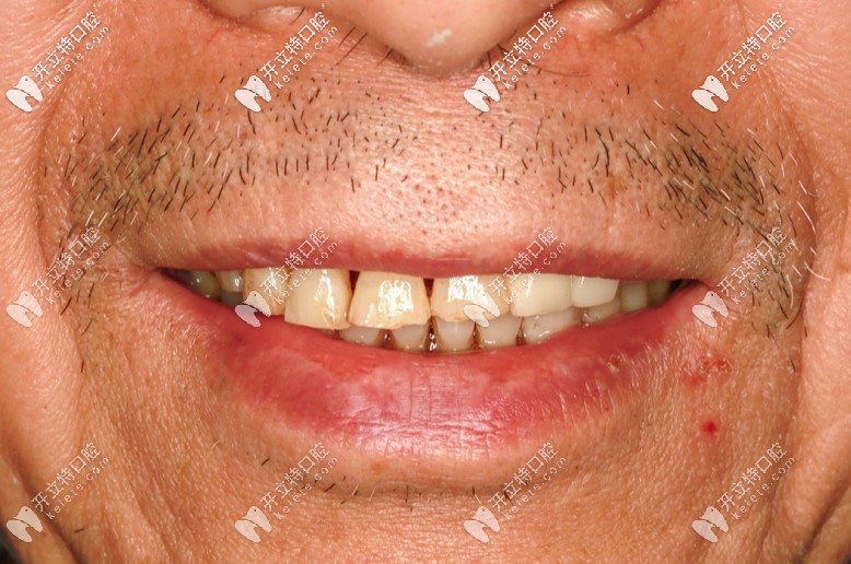 全口种植牙1年效果图 全口种植牙1年效果图