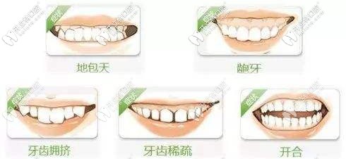 哪些人适合做隐形矫正？