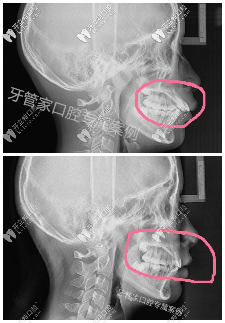 北京牙管家口腔骨性龅牙带牙套有效果，下牙套后我的骨性牙齿内收了6毫米