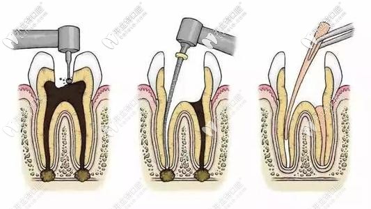清理感染的牙髓