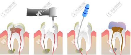 不可逆的牙髓炎治疗方法