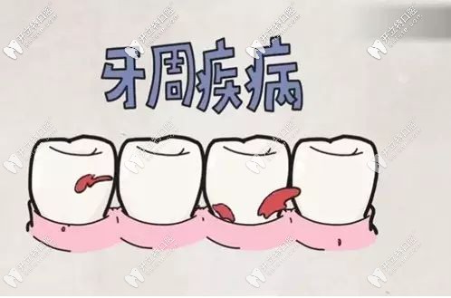 牙周疾病的治疗