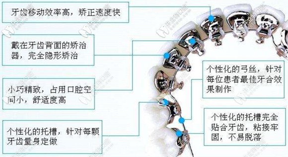 关于舌侧隐形矫正的优点 关于舌侧隐形矫正的优点
