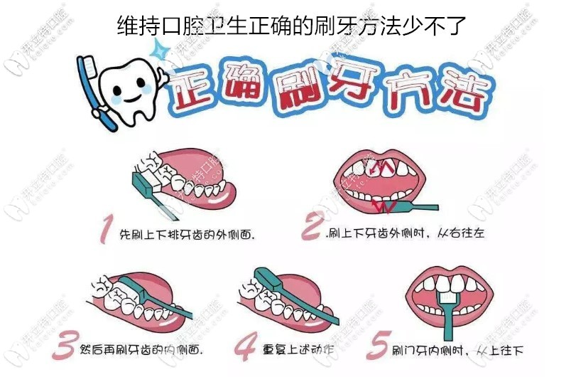 作为一个做了种植牙的过来人建议大家一定要注意口腔卫生
