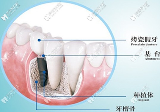 7800元的奥齿泰种植体对于12000元iti种植体