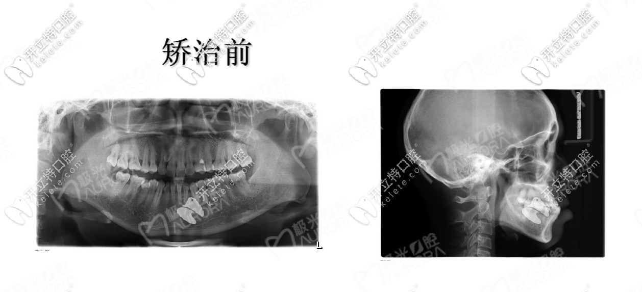 门牙地包天怎么矫正