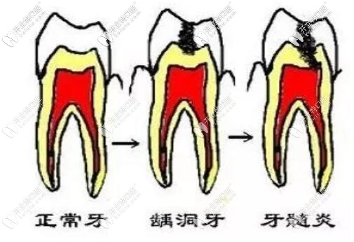 龋齿的发展过程