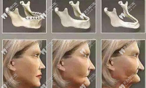 牙槽骨吸收人变老的图片