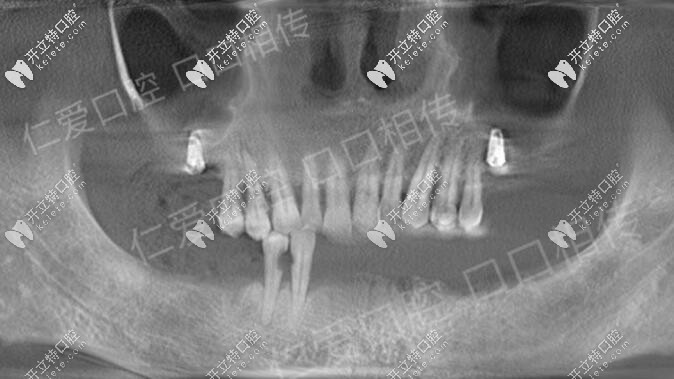 武汉仁爱口腔武汉私立牙科all-on6半口种植牙成功,登腾价格便宜老人够用了