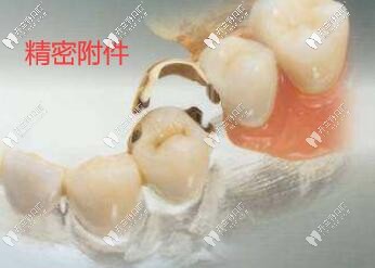 精密附着体义齿 精密附着体义齿