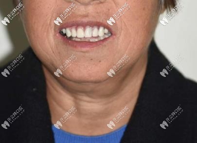 63岁阿姨植入种植体恢复一口好牙