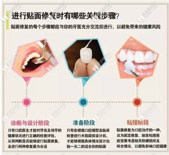 牙齿瓷贴面详细步骤和流程