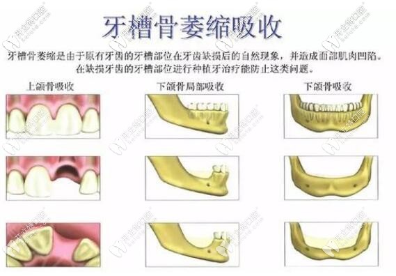 牙槽骨萎缩吸收 牙槽骨萎缩吸收