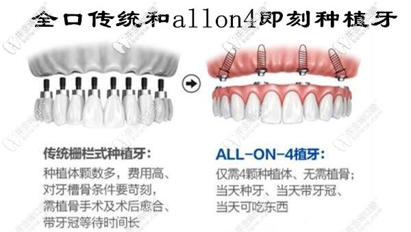 全口传统种植牙和allon4即刻负重种植牙