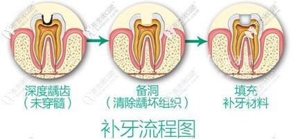 儿童补牙的流程图