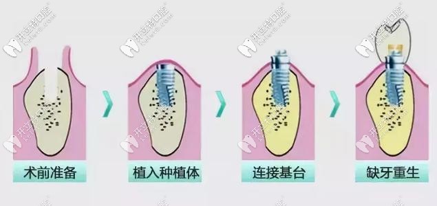 种植牙的过程