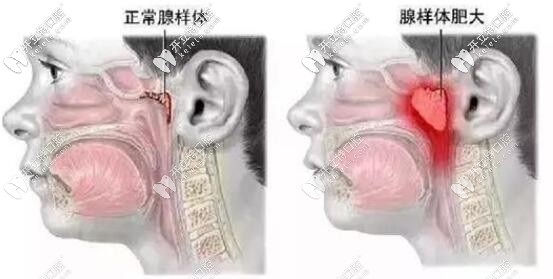 腺样体肥大