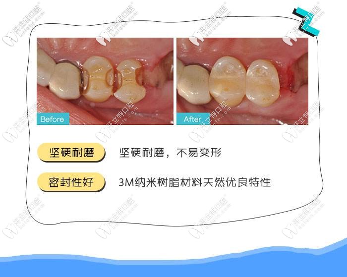 3M树脂补牙的优点