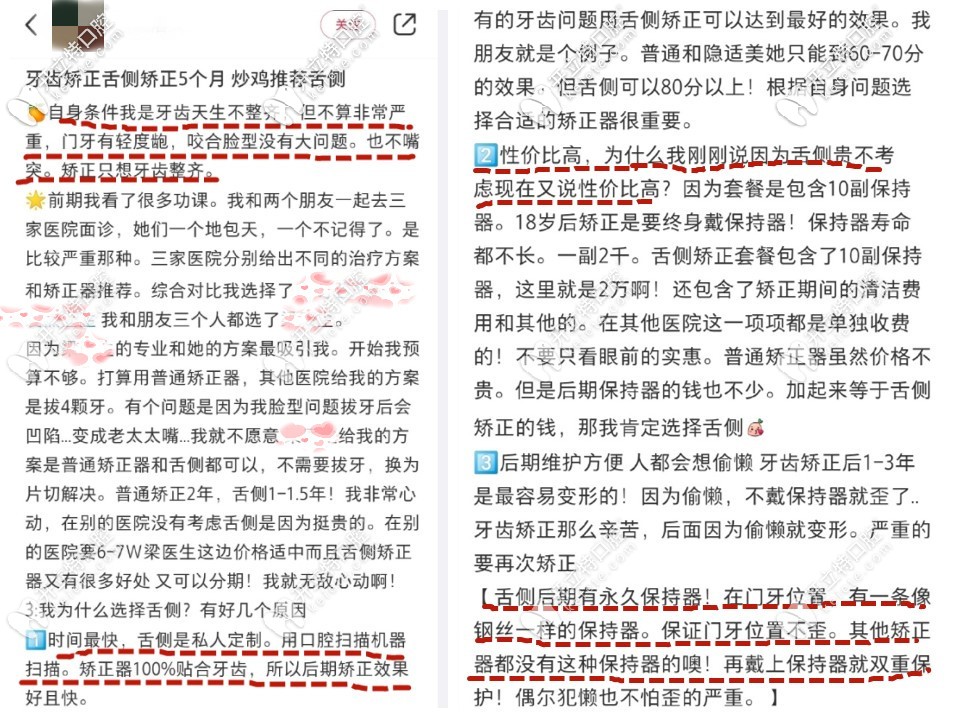 舌侧隐形矫正亲身经历者评价