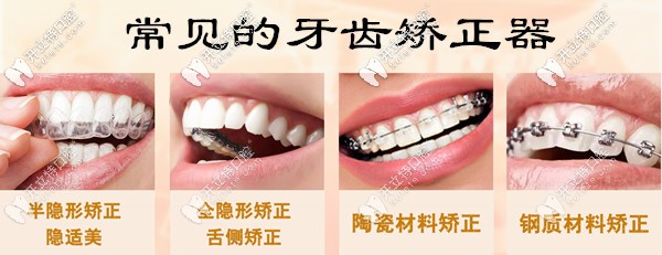 苏州地区常用的牙齿矫正器