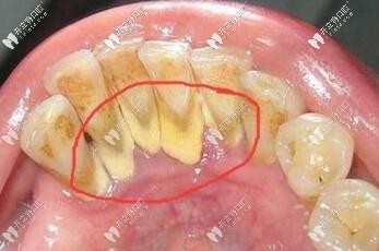 牙菌斑洗牙的必要性