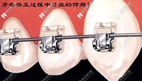 千万别小瞧了牙齿矫正过程中弓丝的作用和原理