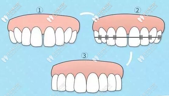 金属托槽牙齿矫正中弓丝的作用是什么