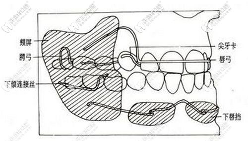 活动矫正器结构图