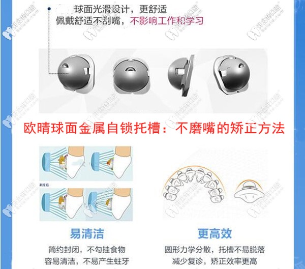 欧晴金属自锁托槽牙齿矫正的优势