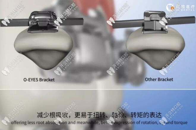 欧晴自锁托槽矫正速度更快