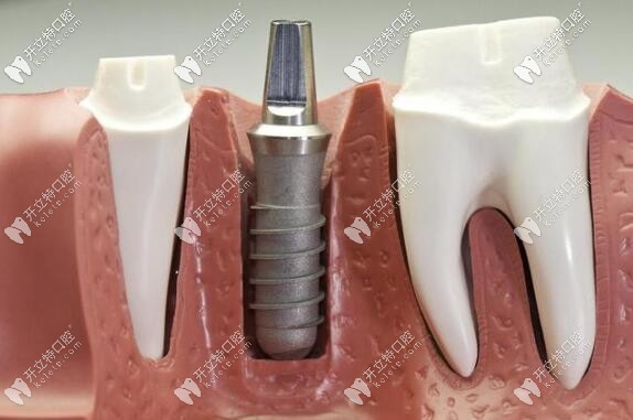 种植牙牙龈部分图示