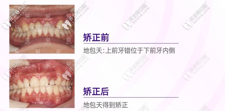 重庆美奥口腔地包天矫正案例