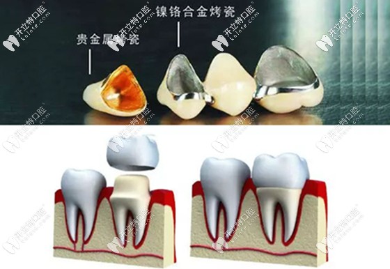 烤瓷牙的材质和结构图