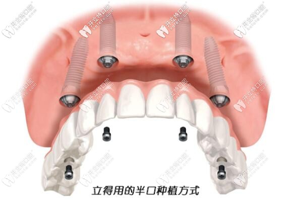 立得用半口种植牙