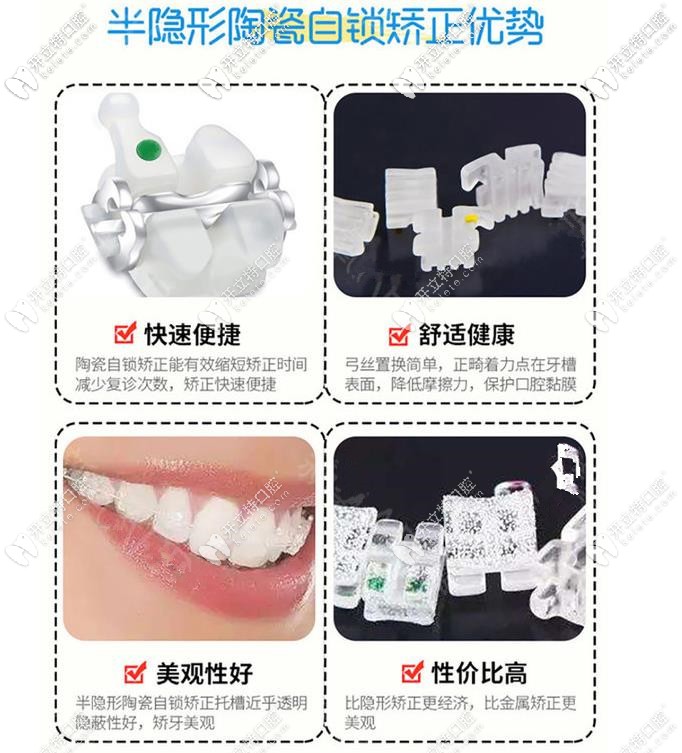 陶瓷自锁矫正优势 陶瓷自锁矫正优势