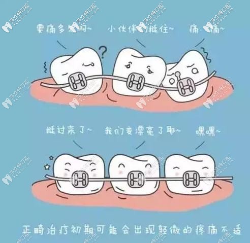 牙齿矫正的移动过程