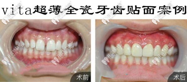 德国vita瓷贴面的效果怎么样
