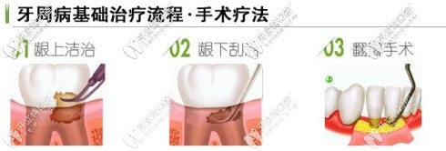 牙周病的治疗过程