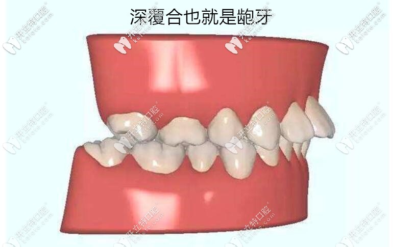 北京国医康口腔苑主任来告诉大家纯股型龅牙是需要做手术的矫正无效