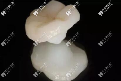 牙齿缺损嵌体修复