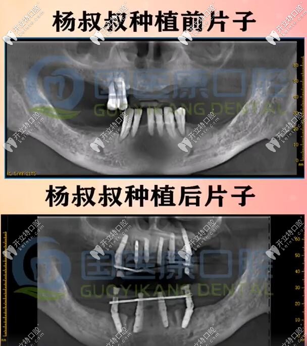 北京国医康口腔71岁杨叔做一日得全口种植牙种了10颗植体，上半口6下半口4