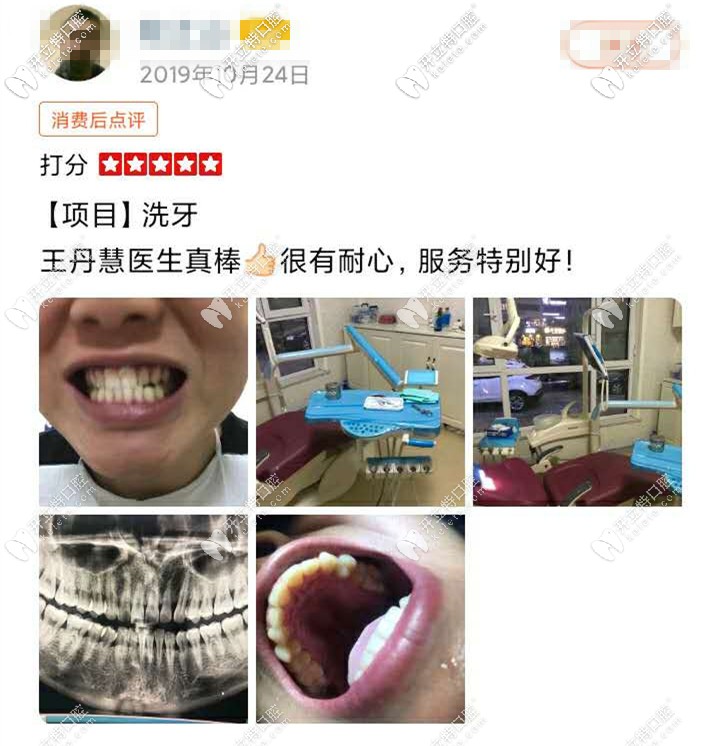 洗牙前后对比图