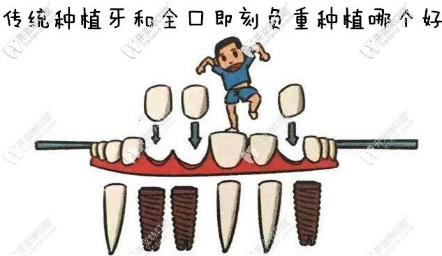 传统种植牙和即刻负重种植牙哪个好？